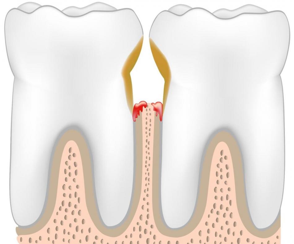 Что такое кариес зубов и откуда он берется?